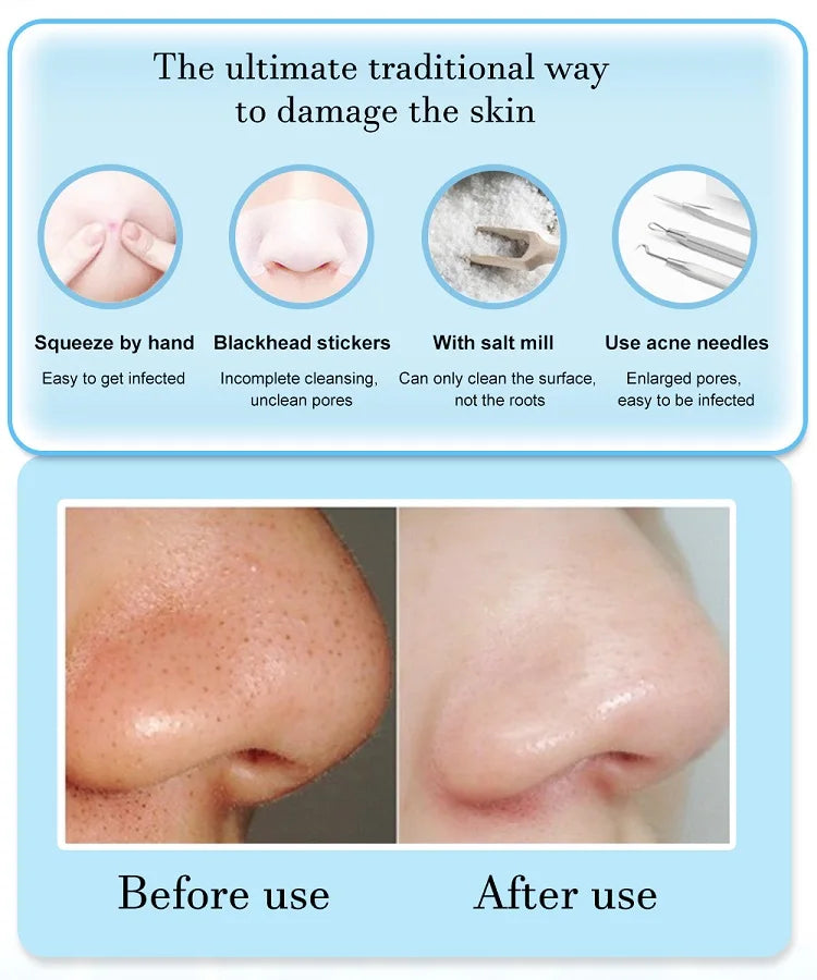 Dead Skin and Blackhead Removal Vacuum